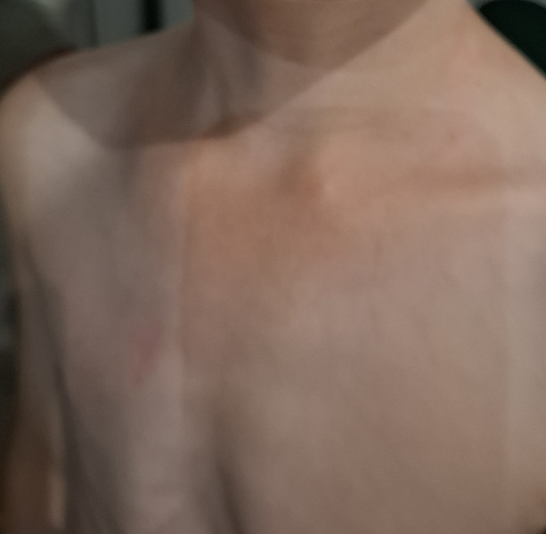 DS7 Pea Size Lump on Collarbone (pic included)
