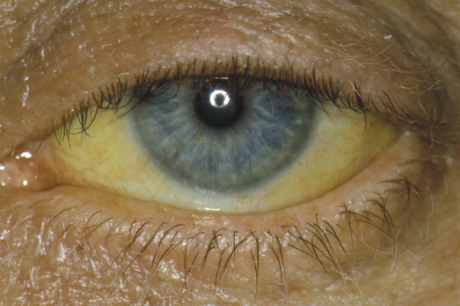 To think that this is jaundice in eye? Photo attached