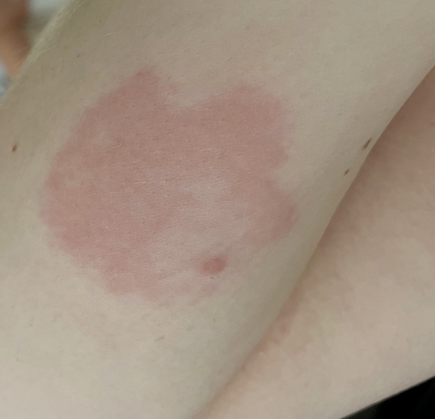 Antihisan cream in pregnancy