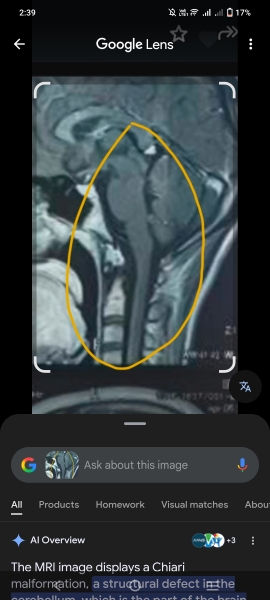 Anyone else have cranio cervical instability?