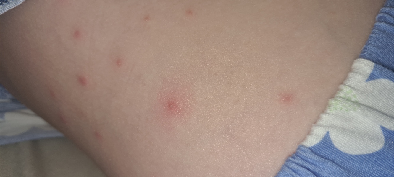 What's biting my daughter