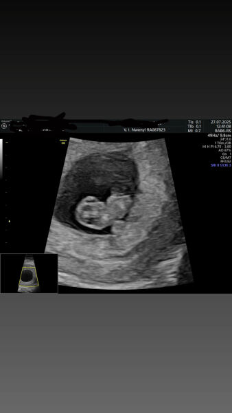 5 week scan…