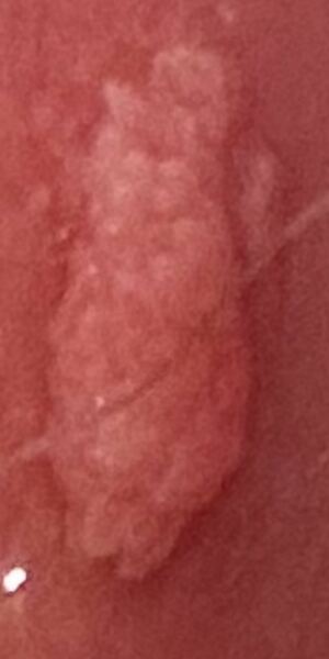 Skin Colour Lump On Labia vagina Mumsnet Skin Colour Lump On Labia vagina Mumsnet