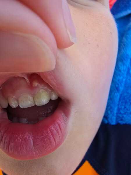 Any paediatric dentists? Potential dead tooth and abscess?