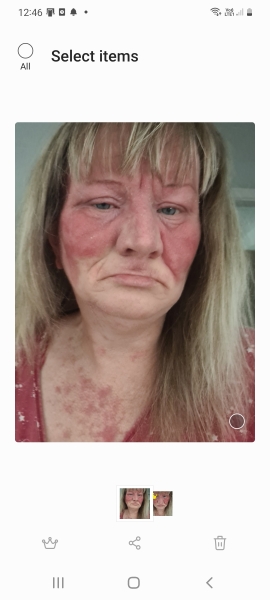 Immunosupressant Abrocitinib