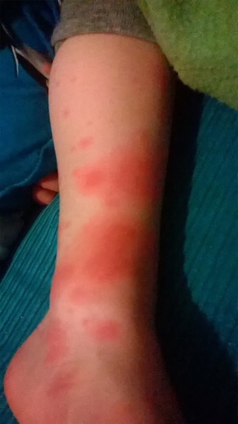 Help please - persistent low grade fevers and Petechiae two year old