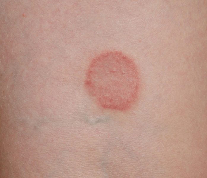 What the heck is this circular rash type thing on my back?