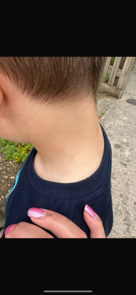 Birth mark? Skin damage? Uneven tan?