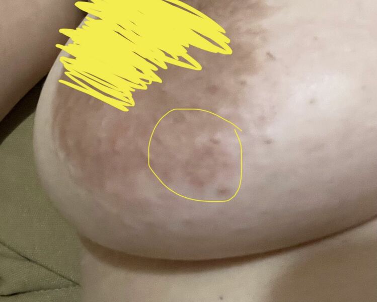 Worried if its breast cancer