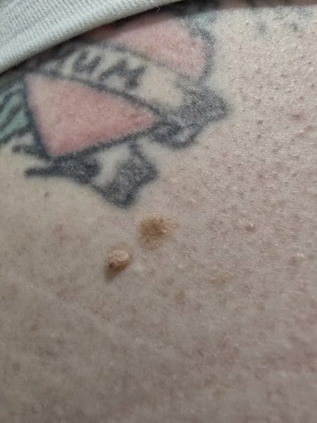 Any ideas what might be going on with DP's scabby mole? Picture