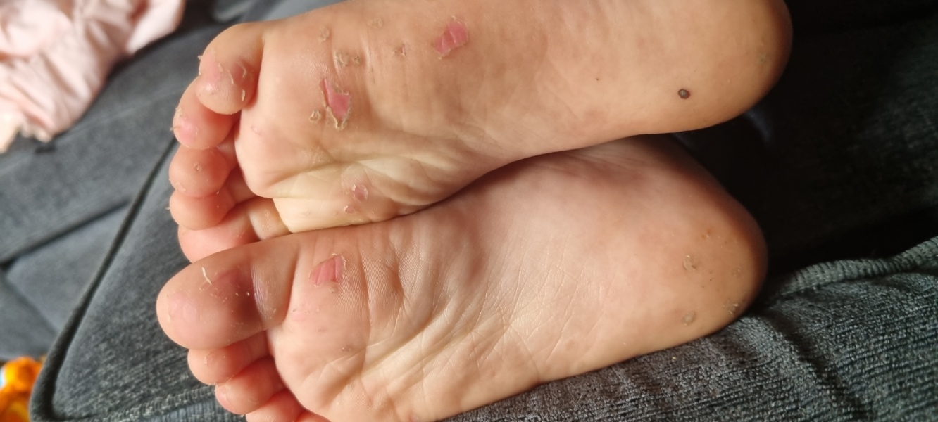 Ds Funny rash on feer