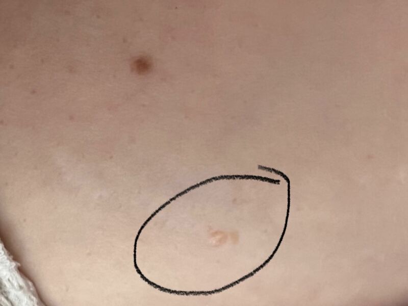 A mole or something else? Clear tan spot on breast?