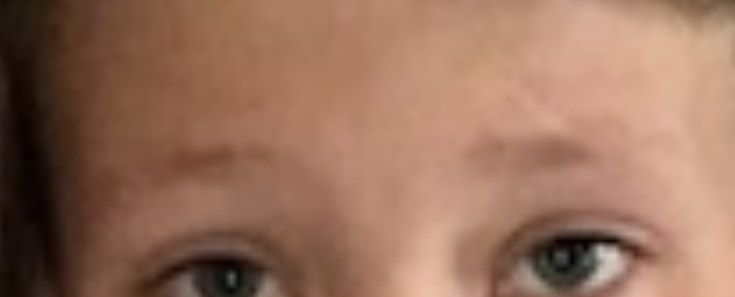 Toddler facial scarring