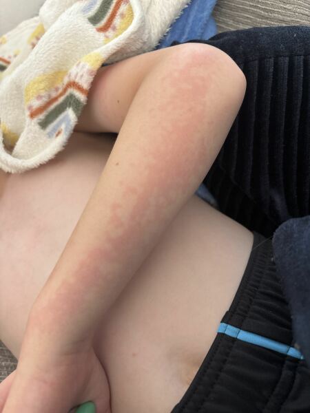 Is this heat rash or a reaction?