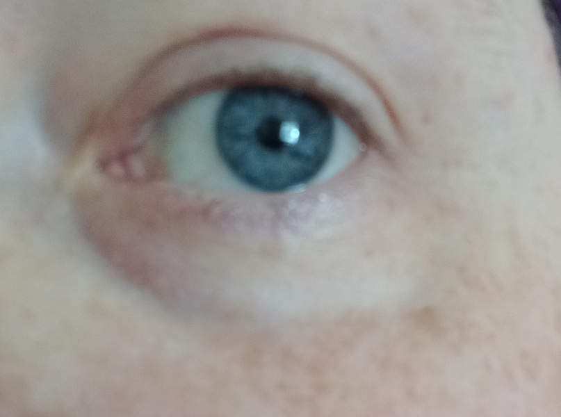 Discolouration around eyes
