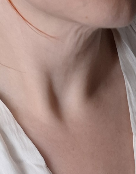 What would you rather have, a belly or a wrinkly neck?