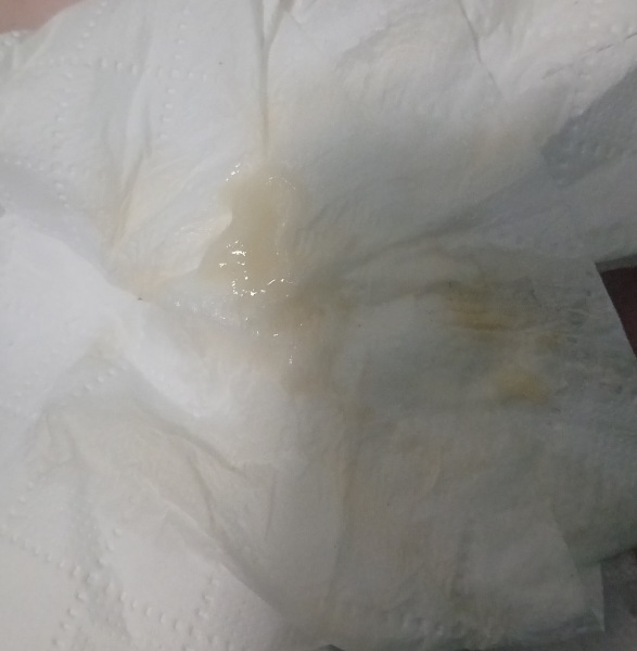 Is this discharge normal?