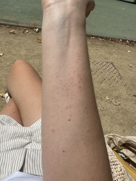 Itchy rash first trimester