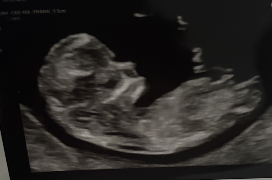 11 weeks 3 days boy or girl?