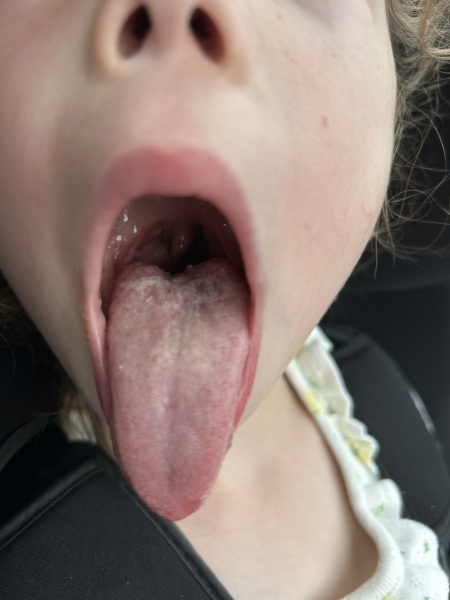 Is this tonsillitis? Pic attached!
