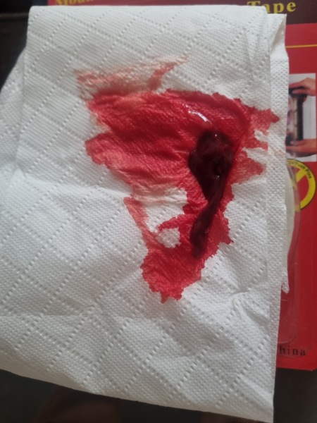 Heavy bleeding 8 weeks pregnant