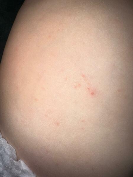 Chicken pox?