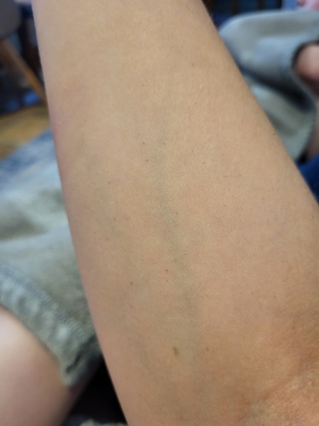 Petechiae or cherry angioma? Talk me down