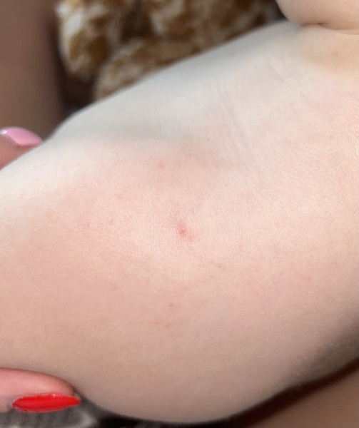 Is this chickenpox?