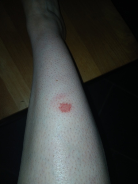 Does this horsefly bite look infected?