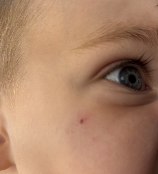 Angry looking mole on toddlers face