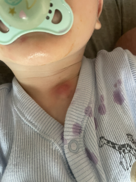 Does this cyst look infected? Pics attached