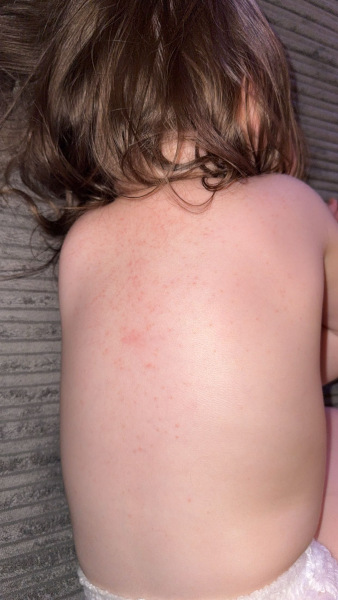 Random rash on my 1yo back