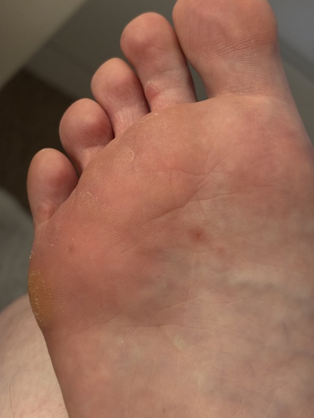Are these verrucas? Pic included - sorry