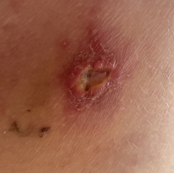 Infection wound post surgery?!