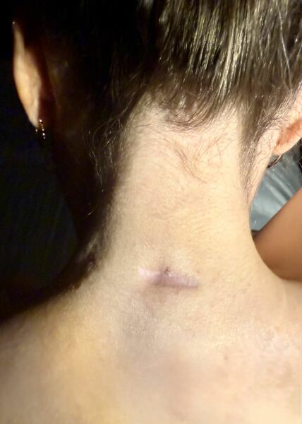 Mother of all sebaceous cysts