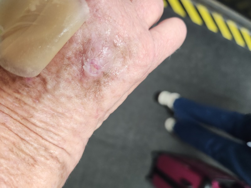 Do I need an antibiotic?