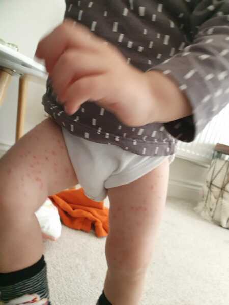 Is this chickenpox?