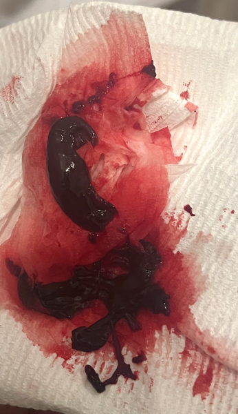 Is it safe to say I miscarried