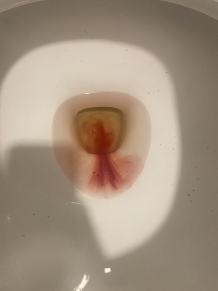 TW:MISCARRIAGE at 6 weeks *pictures*