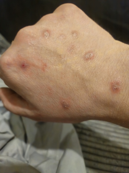 Identify my bites!