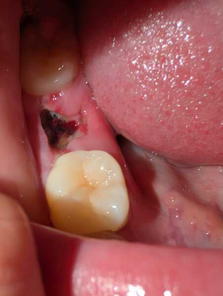 Tooth extraction healing