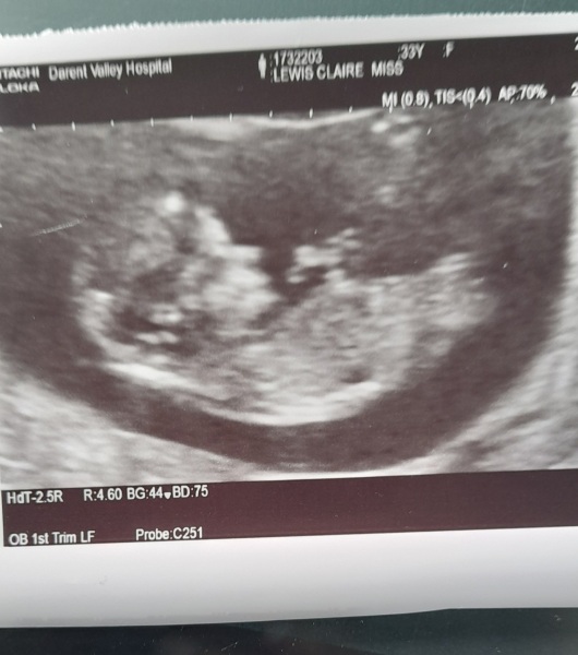 12 week scan