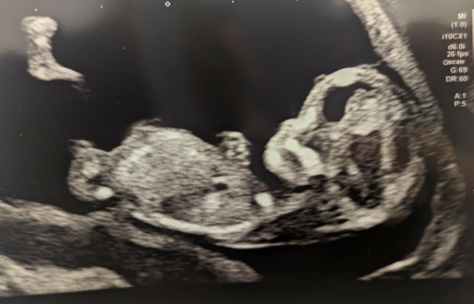 12 week scan - boy or girl?