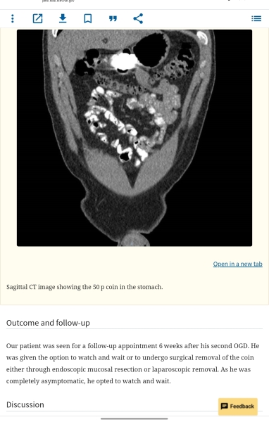 2 year old daughter swallowed a 50p coin !!!