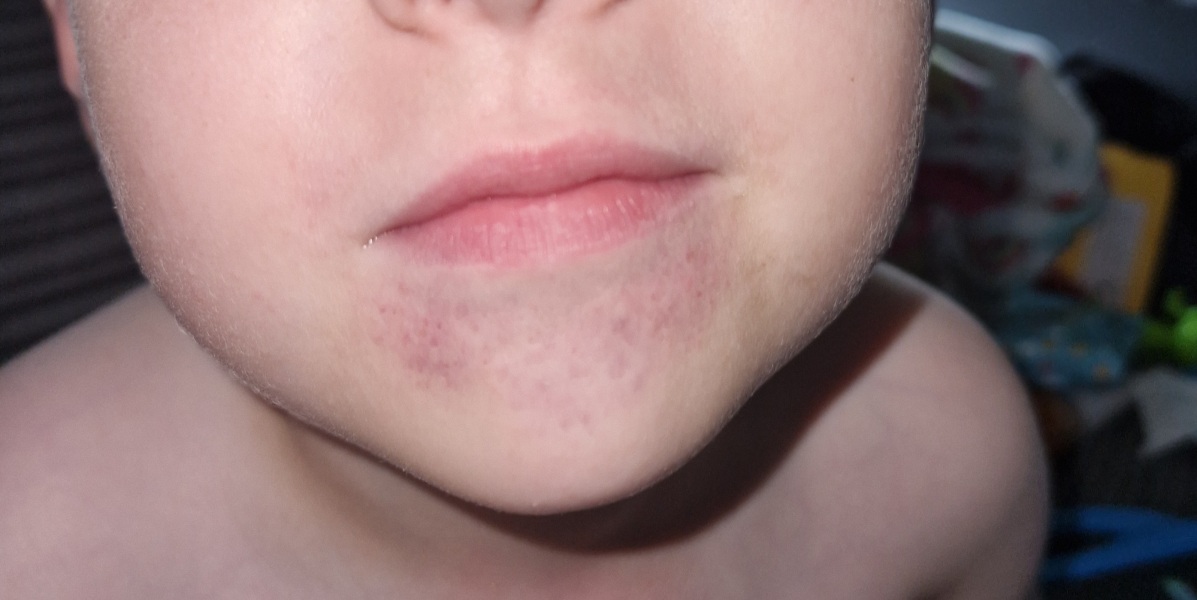 Bruise like rash on chin?