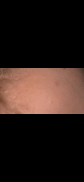 To ask if this looks like the start of chicken pox?