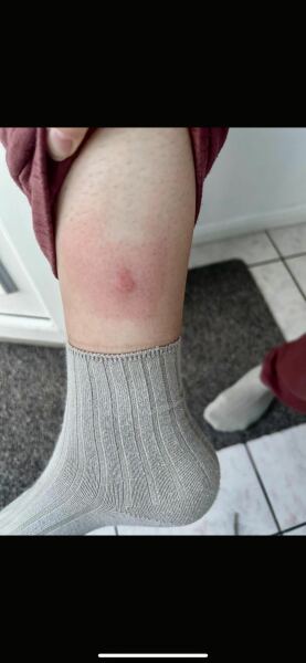 Horsefly bite or just a mozzie ?