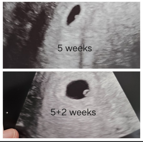 5 week scan…