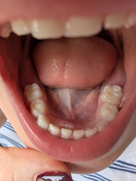 Worried about childs tooth- picture included