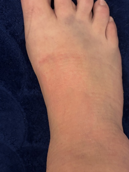 Foot bruising and swelling after 3.5 weeks